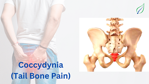 Coccydynia (Tailbone Pain)