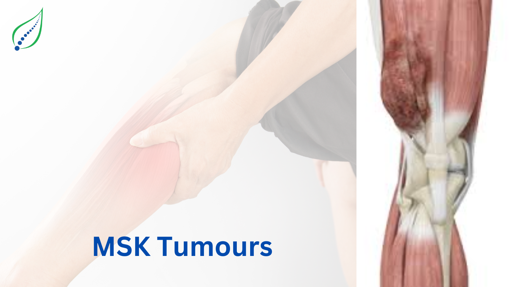 MSK Tumours